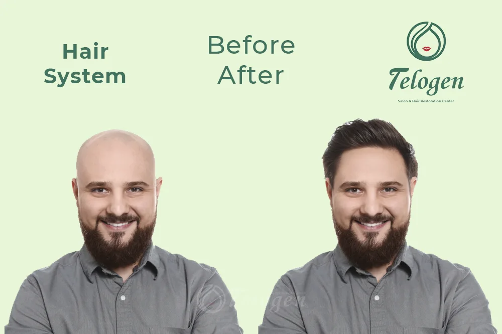 Before-after-hair-system-telogen-1b