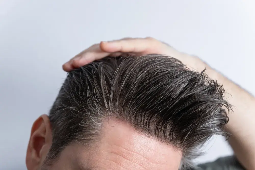 hair-system-Telogen-new-jersey-4