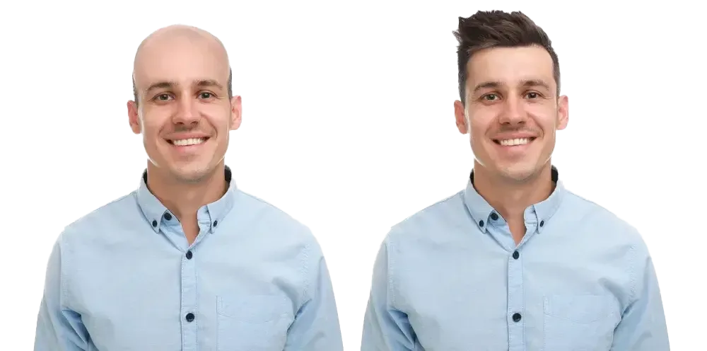 Hair System Replacement Toupee Non Surgical New Jersey York 28