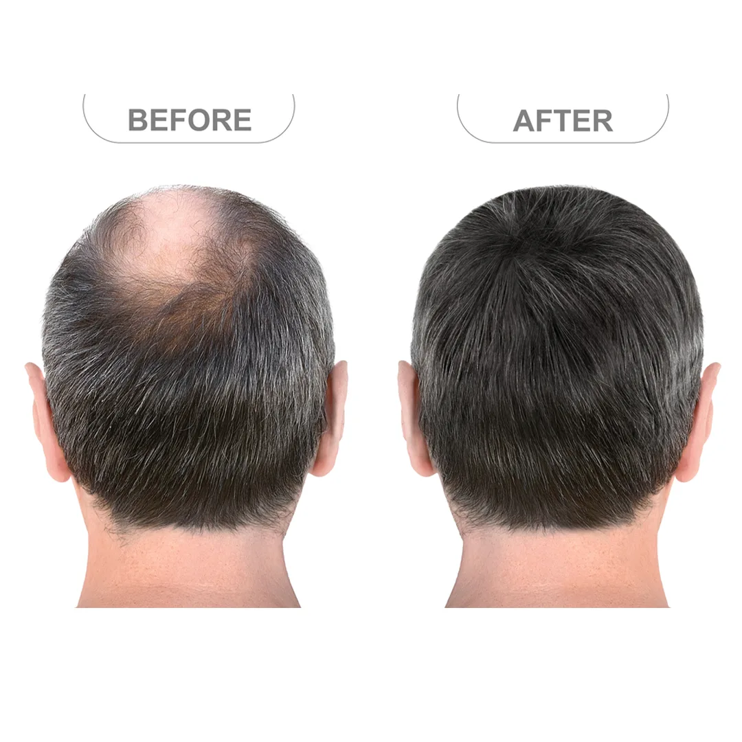 Hair-loss-telogen-restoration- (13)