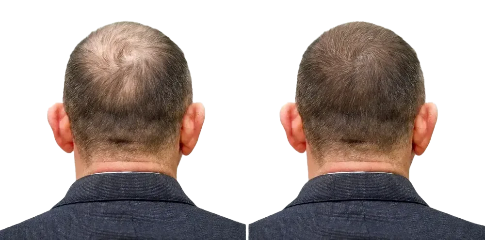 hair-loss-Telogen-new-jersey-4